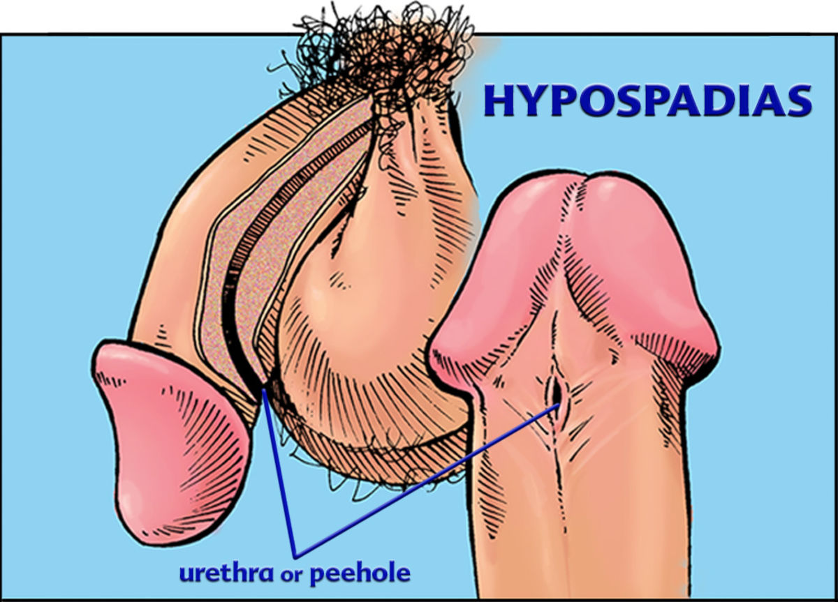 Hypospadiasâ€”A Very Common Male Birth Defect | Psychology Today