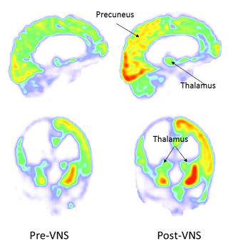 vagus nerve stimulation can restore consciousness psychology today