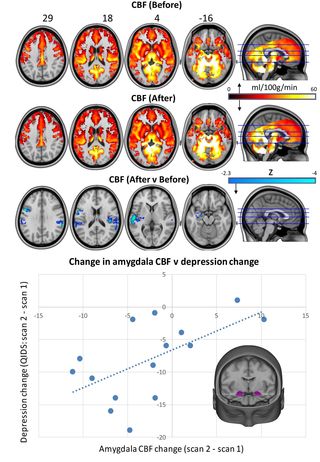 Courtesy of Carhart Harris, R et al. Scientific Reports 2017