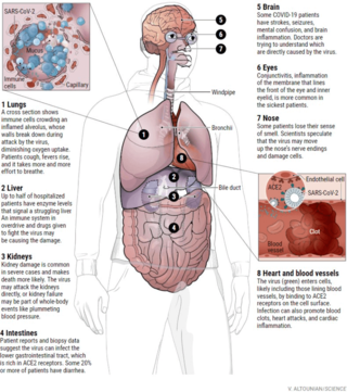 How does coronavirus kill? Clinicians trace a ferocious rampage through the body, from brain to toes. Science April 17, 2020.