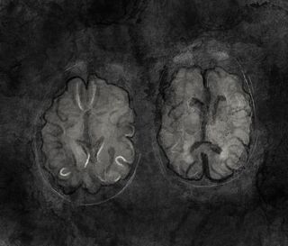 Schizophrenia or Traumatic Brain Injury? | Psychology Today Canada