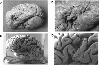 Dronkers et al., 2007 Dronkers et al., 2007