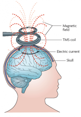 Transcranial Magnetic Stimulation (TMS) Treats Depression | Psychology ...