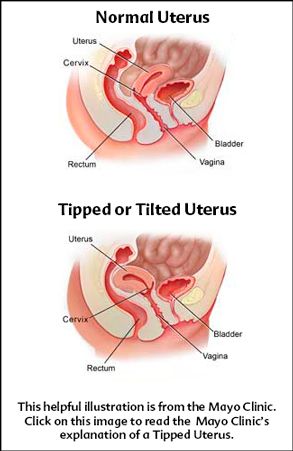 Sex position with inverted uterus