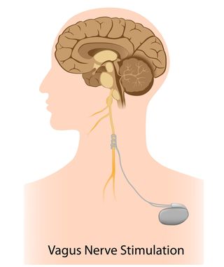 Vagus Nerve Stimulator - Dr. Diane Brain Health