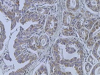 "Breast cancer (Infiltrating ductal carcinoma of the breast) assayed with anti HER-2 (ErbB2) antibody"/Itayba/CC BY-SA 3.0