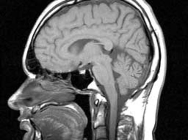 "MRI Scan of a Head" by Ranveig/CC BY-SA 3.0