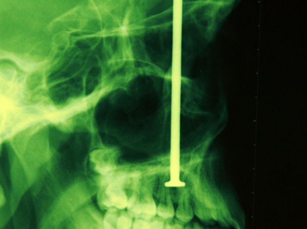 Denver Post staff/Denver Post file/Used with permission.