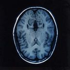 Brain Surgery for Obsessive-Compulsive Disorder: A Cautionary Note