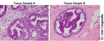 Core biopsies - DCIS Dilemma