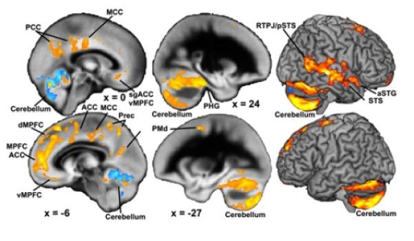 Brain volume changes caused by family problems in orange and blue.