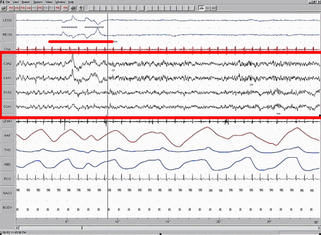 Rapid eye movement sleep (in red zone) on an EEG.