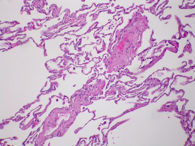 Pulmonary veno-occlusive disease (PVOD) - Case 269 by Yale Rosen/Flickr Creative Commons Pulmonary veno-occlusive disease (PVOD) - Case 269 by Yale Rosen/Flickr Creative Commons