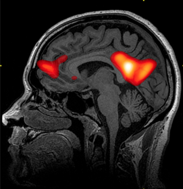 Brain imaging techniques advantages and disadvantages Brain imaging techniques advantages and disadvantages image
