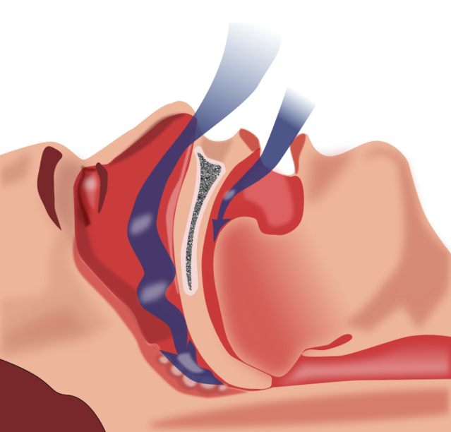 How Sleep Apnea Causes Biochemical Havoc in Your Brain