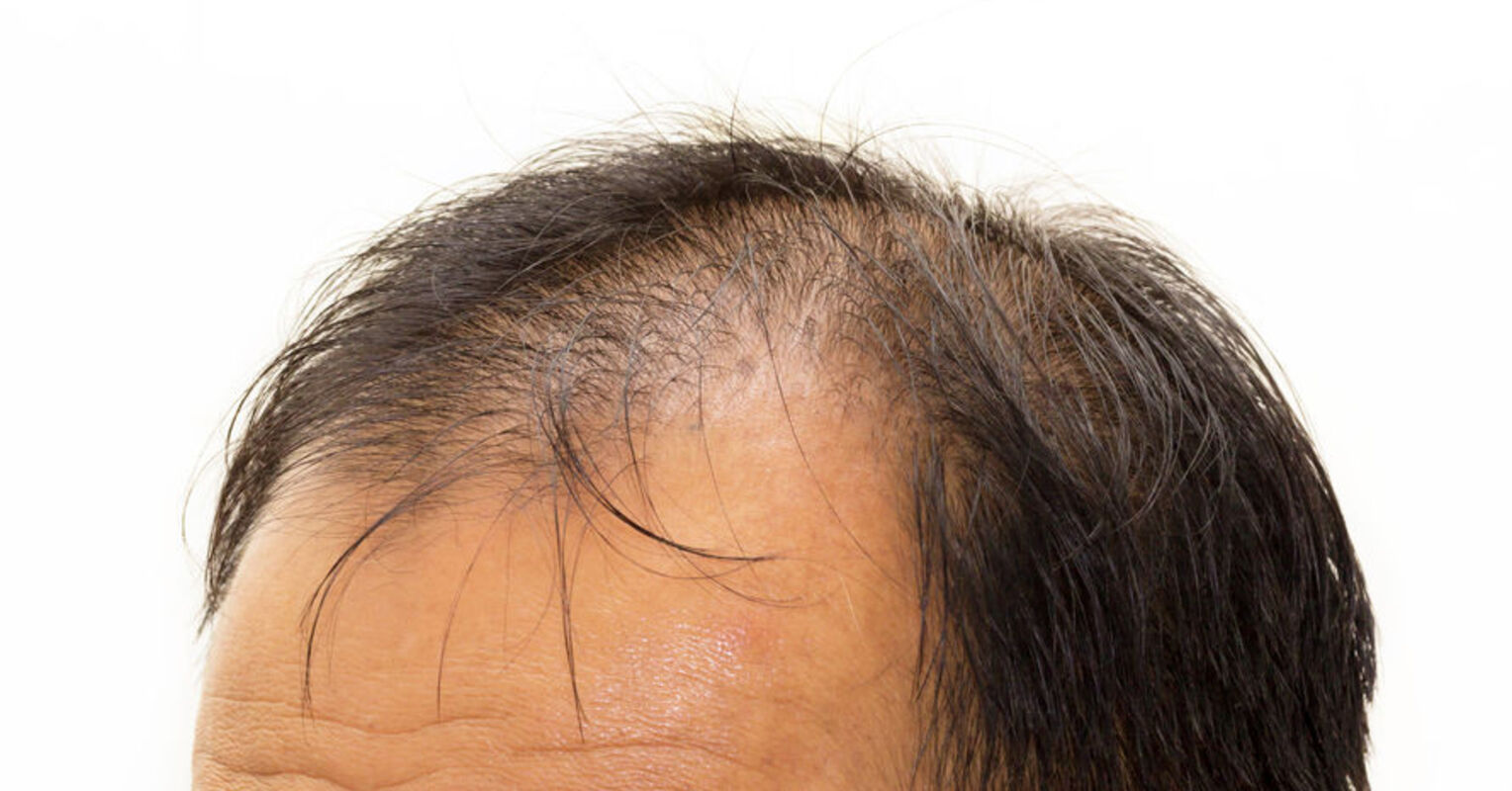4 Tips for Dealing With Coronavirus-Related Hair Loss